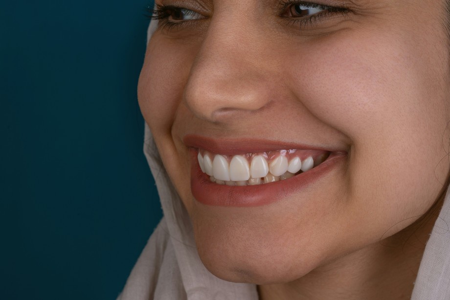 A beautiful woman after Jaw Line Implant