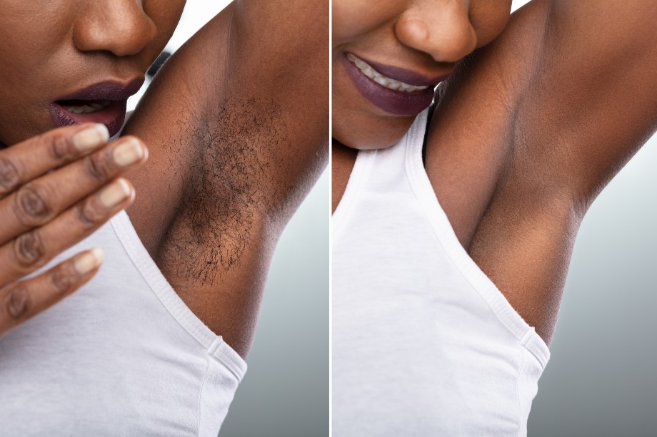 Laser Hair Removal for Darker Skin Tones
