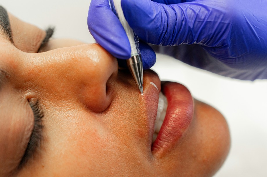 M-Shaped Lip Filler