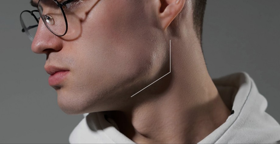long-lasting results of jawline implants