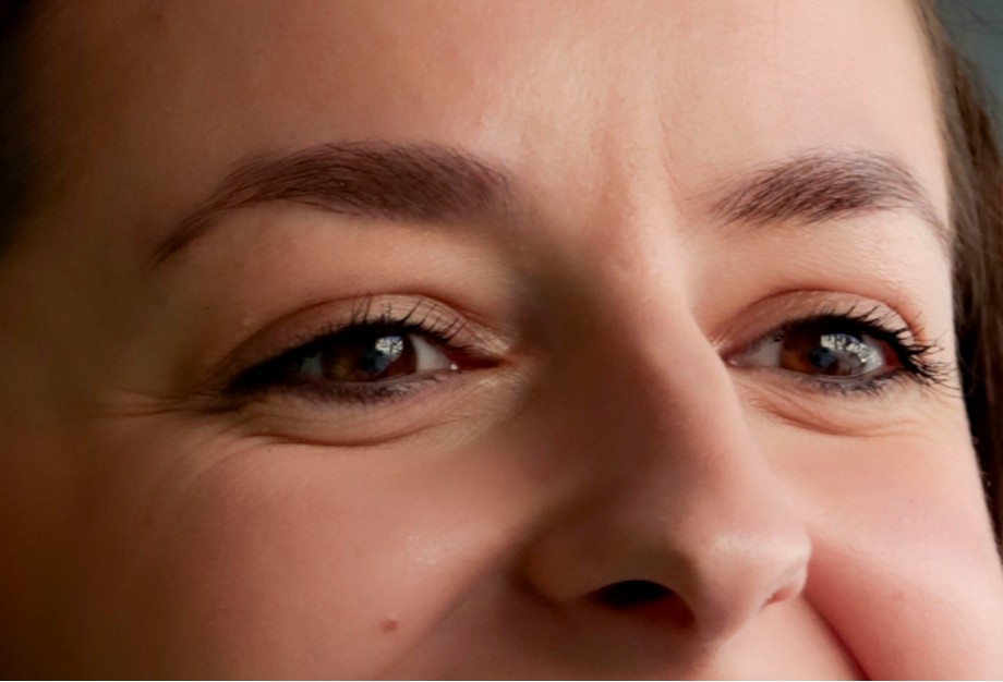 vertical wrinkles between the eyebrows