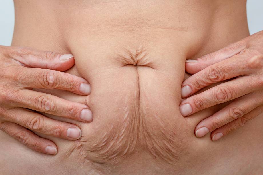 Stretch marks after pregnancy